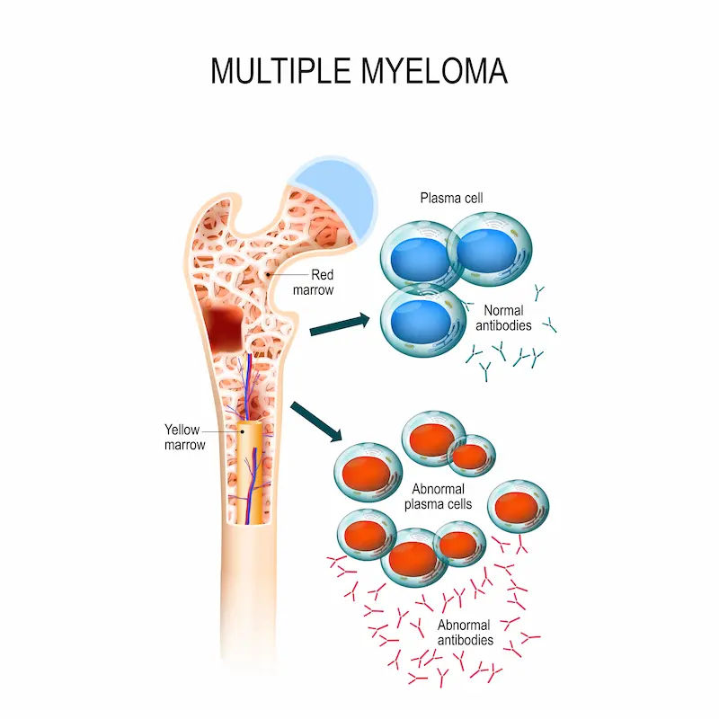 Multiple Myeloma Recognising the Signs and Understanding Your Treatment Options
